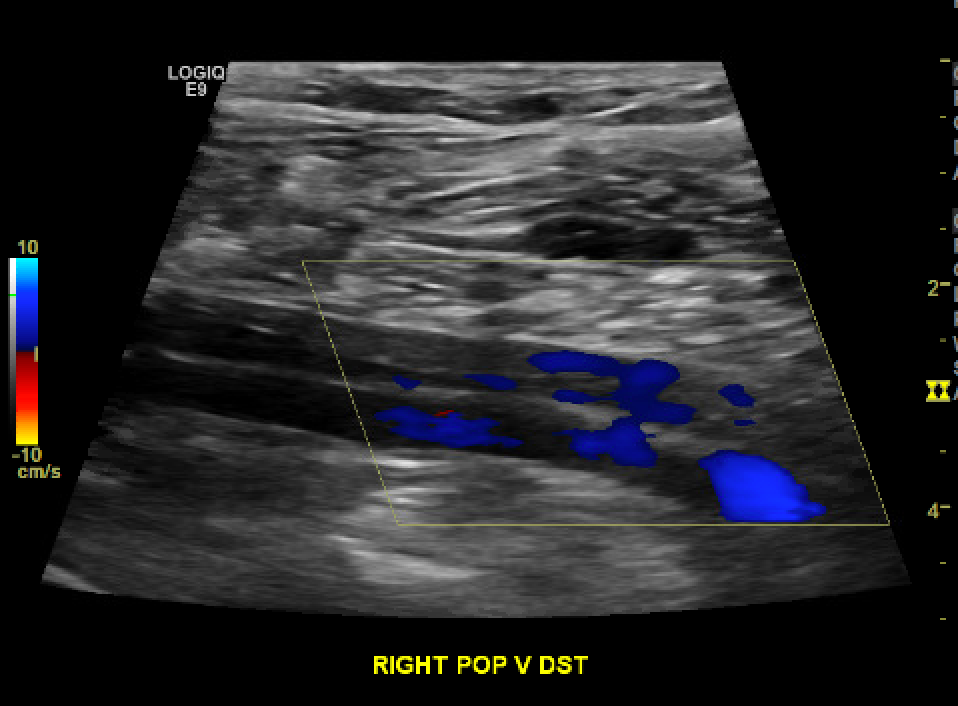 Chronic Non-occlusive DVT within a duplicated popliteal vein