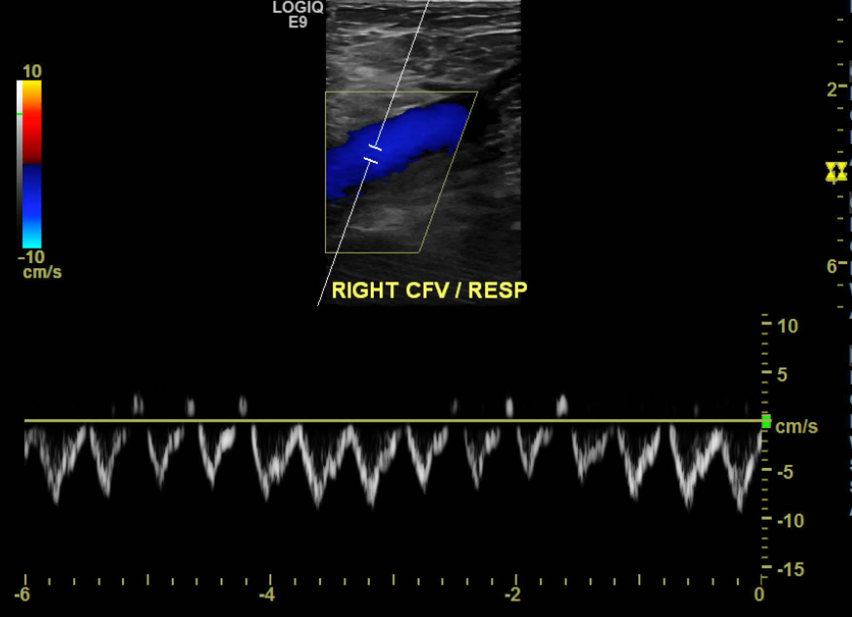 Respiratory phasicty indirectly indicating patency of the iliac veins and the inferior vena cava.