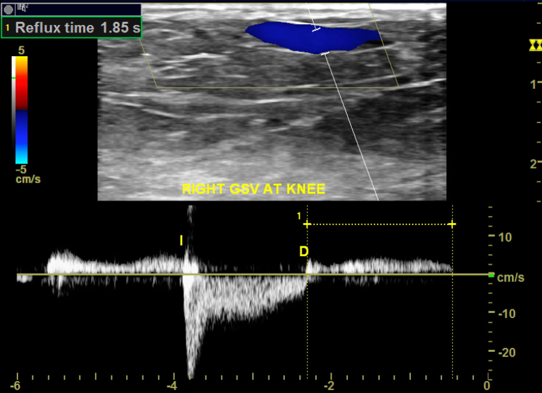 Chronic venous insufficiency