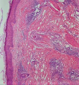 <p>Histopathology of Lichen Planopilaris.</p>