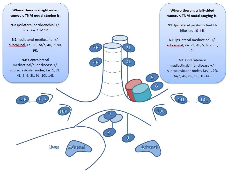 Lympy node station diagram adapted from the International association for the Study of Lung Cancer with annotations detailing nodal staging as defined in the 8th TNM lung cancer staging document