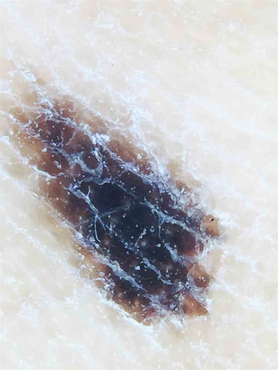 Dermoscopy of left arch nevus exhibiting parallel ridge pattern