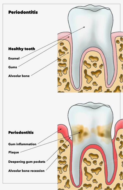 <p>Periodontitis</p>