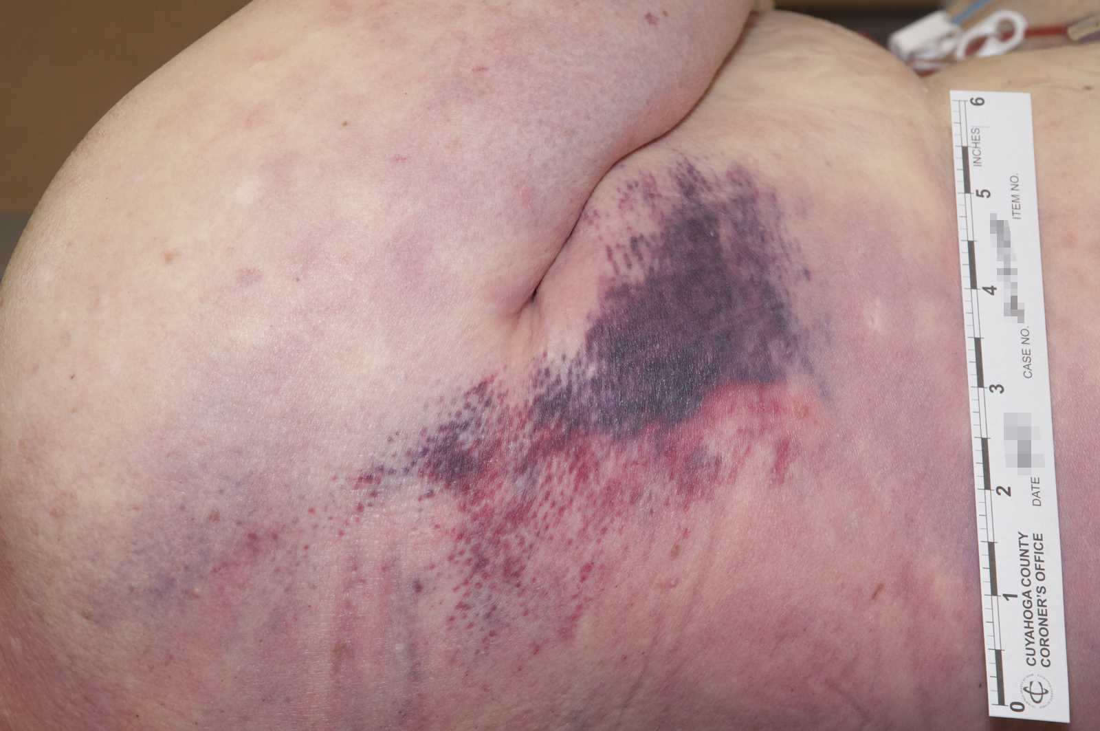 A recent red/purple contusion of the right lateral chest beneath the axilla.