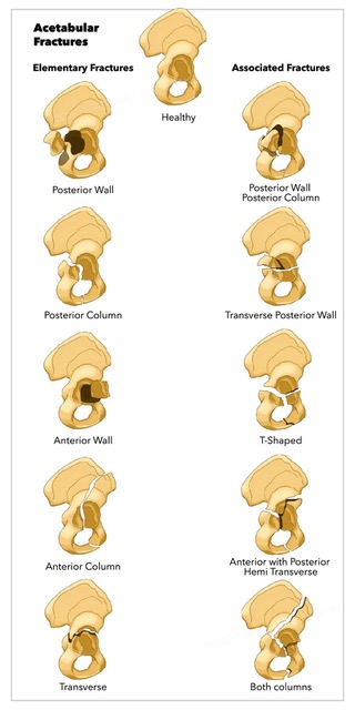 Acetabular Fractures, elementary and associated