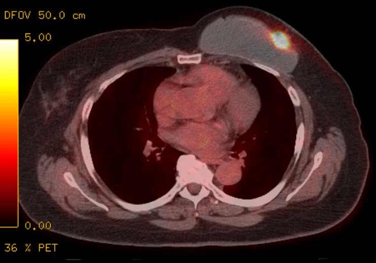 PET/CT scan in a patient with a left breast implant demonstrates focal update along the implant capsule consistent with site of primary cancer