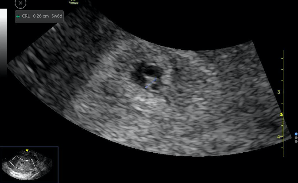 Crown rump length measurement taken along the length of the embryo