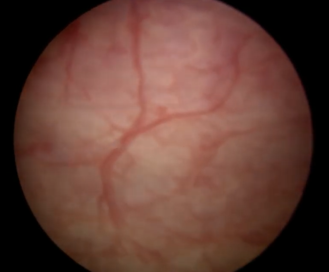 Normal mucosa of the bladder wall, characterised by pale/pink appearance, lack of erythema, swellings, and relatively straight capillaries