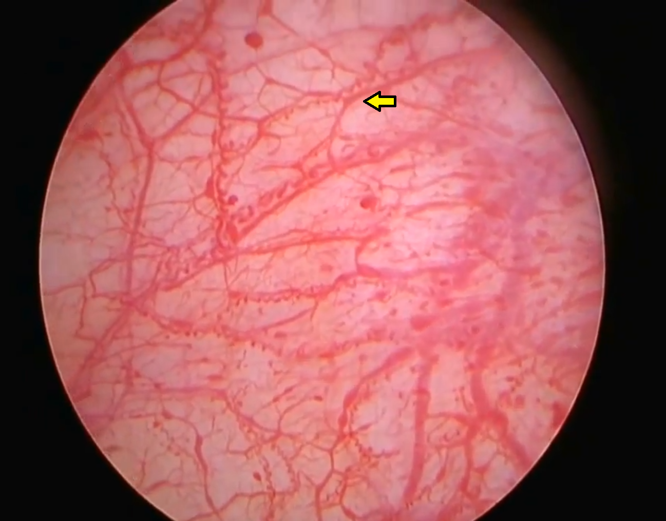 Abnormal mucosa wall, this image shows capillary glomerulations.