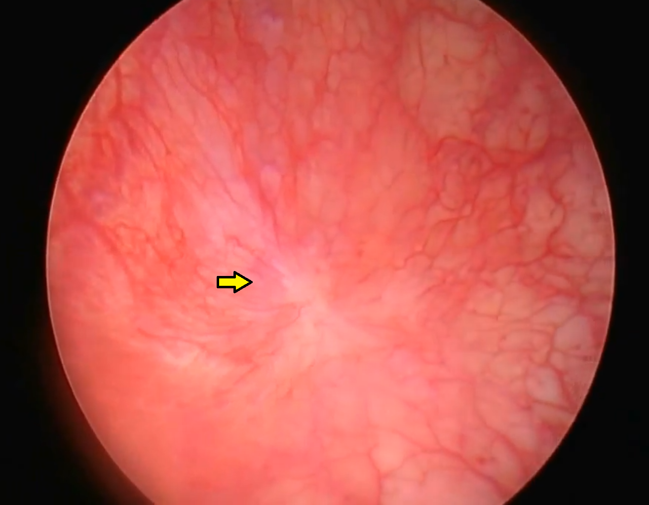 Abnormal bladder mucosa, showing a Hunner's ulcer