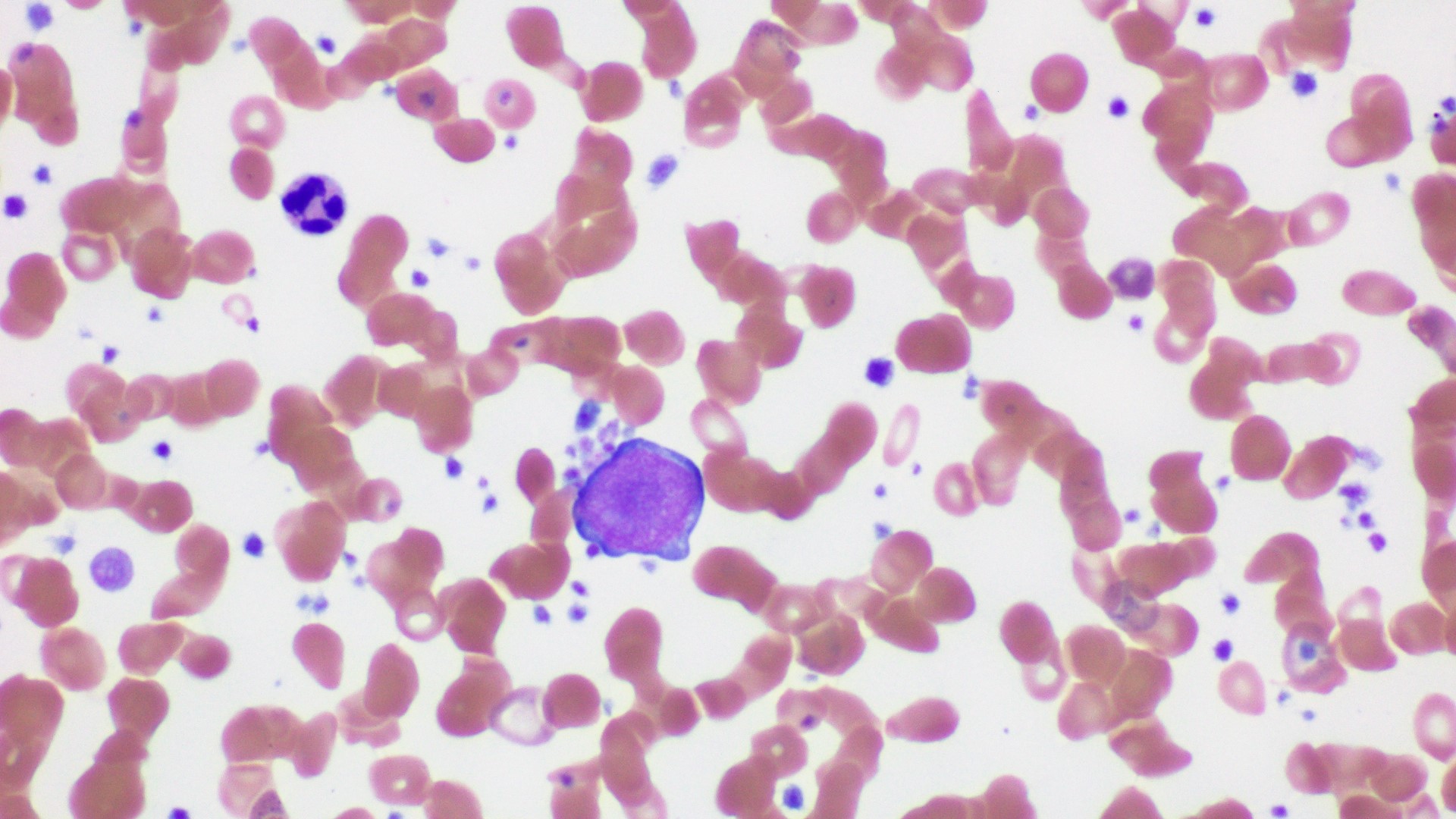 A hematoxylin and eosin (H&E) stained slide showing platelet clumping around a neutrophil.