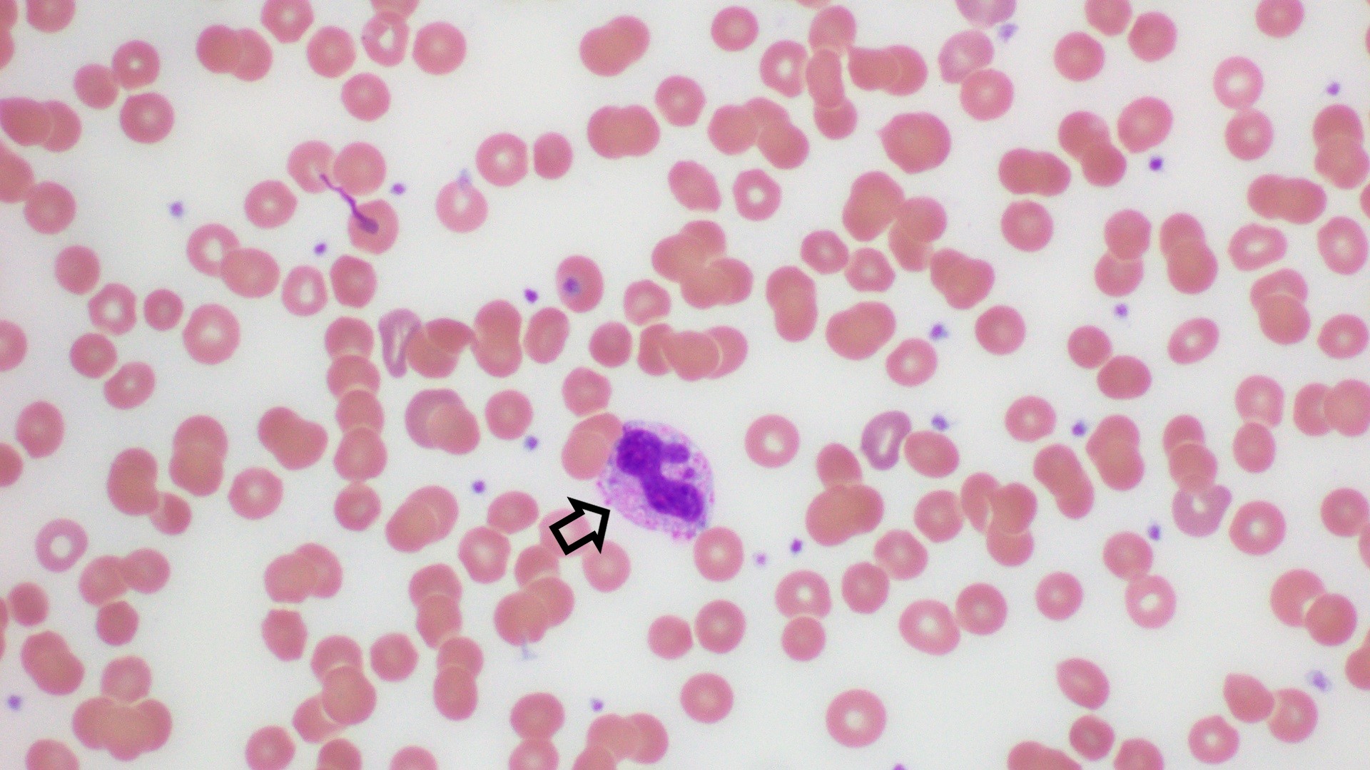 A Hematoxylin and Eosin (H&E) stained slide showing Döhle bodies  that are light blue-gray, oval, basophilic, leukocyte inclusions located in the peripheral cytoplasm of neutrophil (arrow)