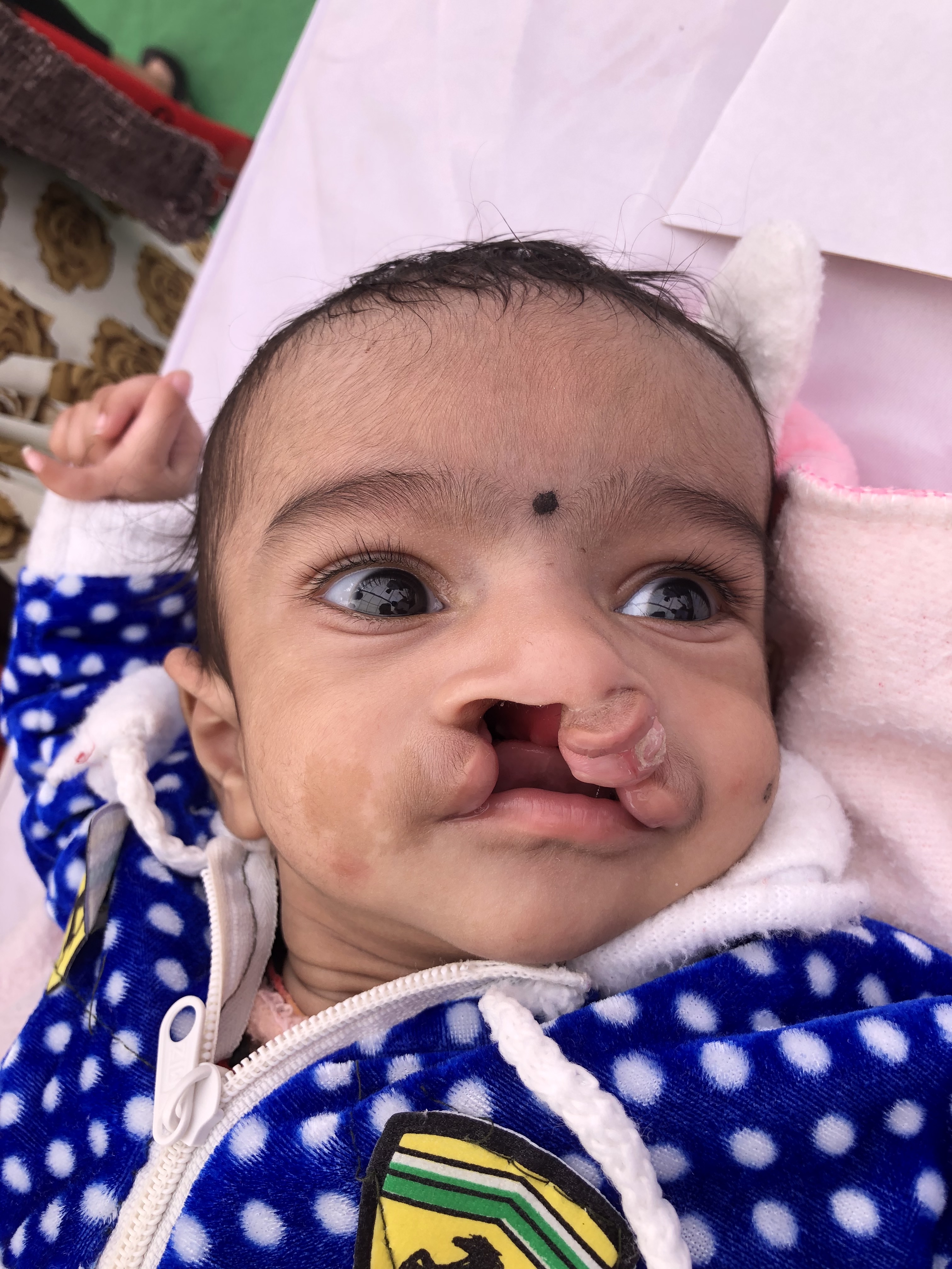 Patient with a bilateral, complete cleft lip and palate