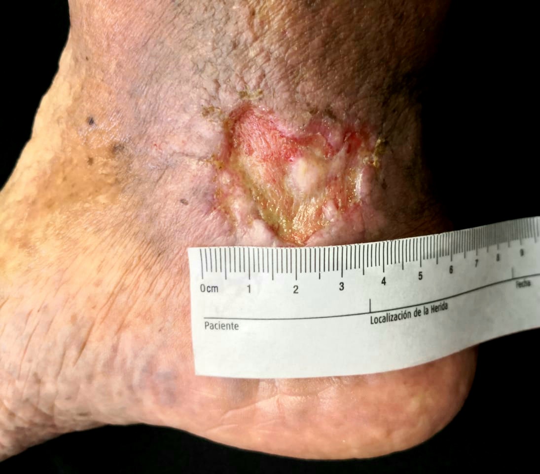 Venous leg ulcer affecting the gaiter area