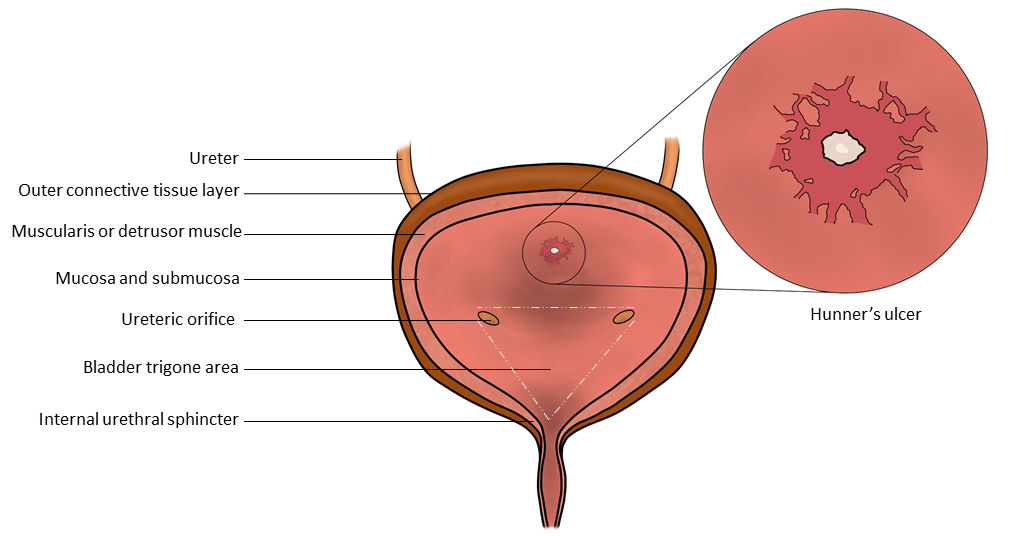 Illustration of the bladder anatomy, with an illustration of a classic Hunner's ulcer located at the posterior bladder mucosa, where it is most commonly found