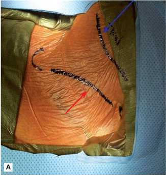 Carotid endarterectomy (CEA) can be performed via a neck incision along the anterior border of the sternocleidomastoid muscle (red arrow)