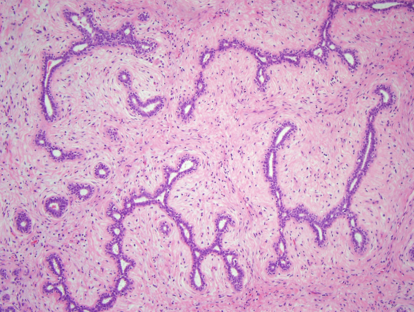 In a fibroadenoma with the intracanalicular pattern the proliferating stroma compresses and distorts ductal epithelium into clefts (x10)