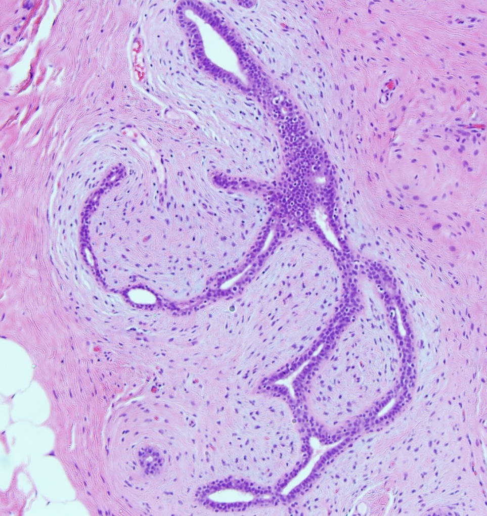 Fibroadenoma with proliferating stroma compressing glands in the breast (x10).