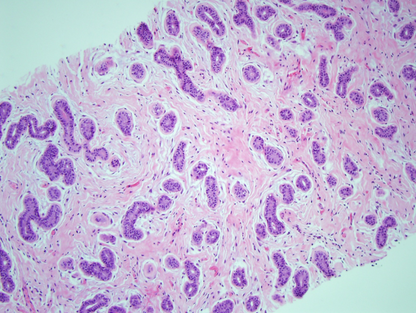 A fibroadenoma with the pericanalicular pattern has stroma proliferating around the gland with open lumens.