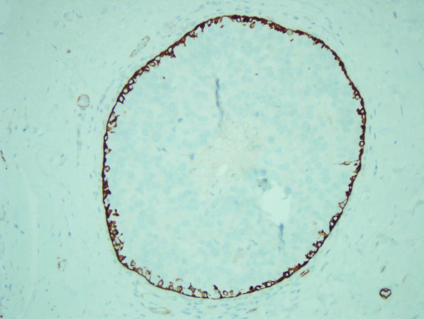 A smooth muscle myosin immunostain showing an intact myoepithelial cell layer in ductal carcinoma in situ, ruling out invasive carcinoma (x10)