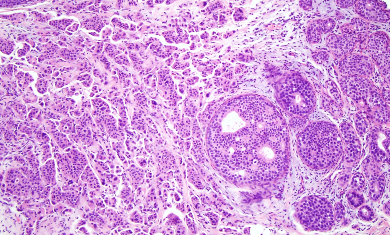 High grade ductal carcinoma in situ with invasive ductal carcinoma (x10)