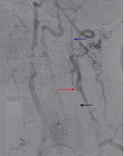 An example of collateralization in a patient with left common carotid artery (CCA) occlusion