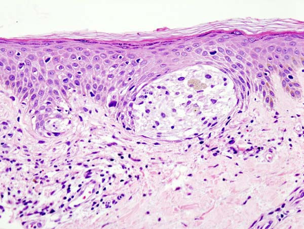 Malignant melanoma