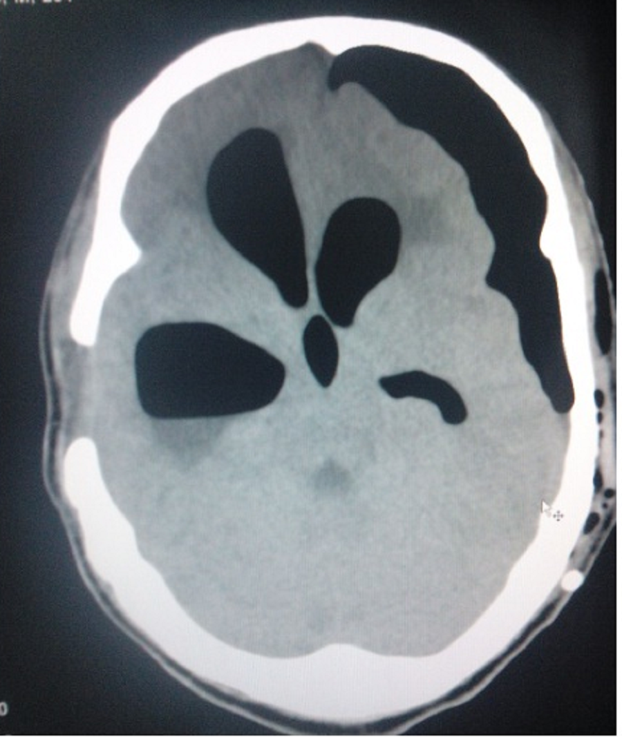 Pneumocephalus and pneumoventriculi