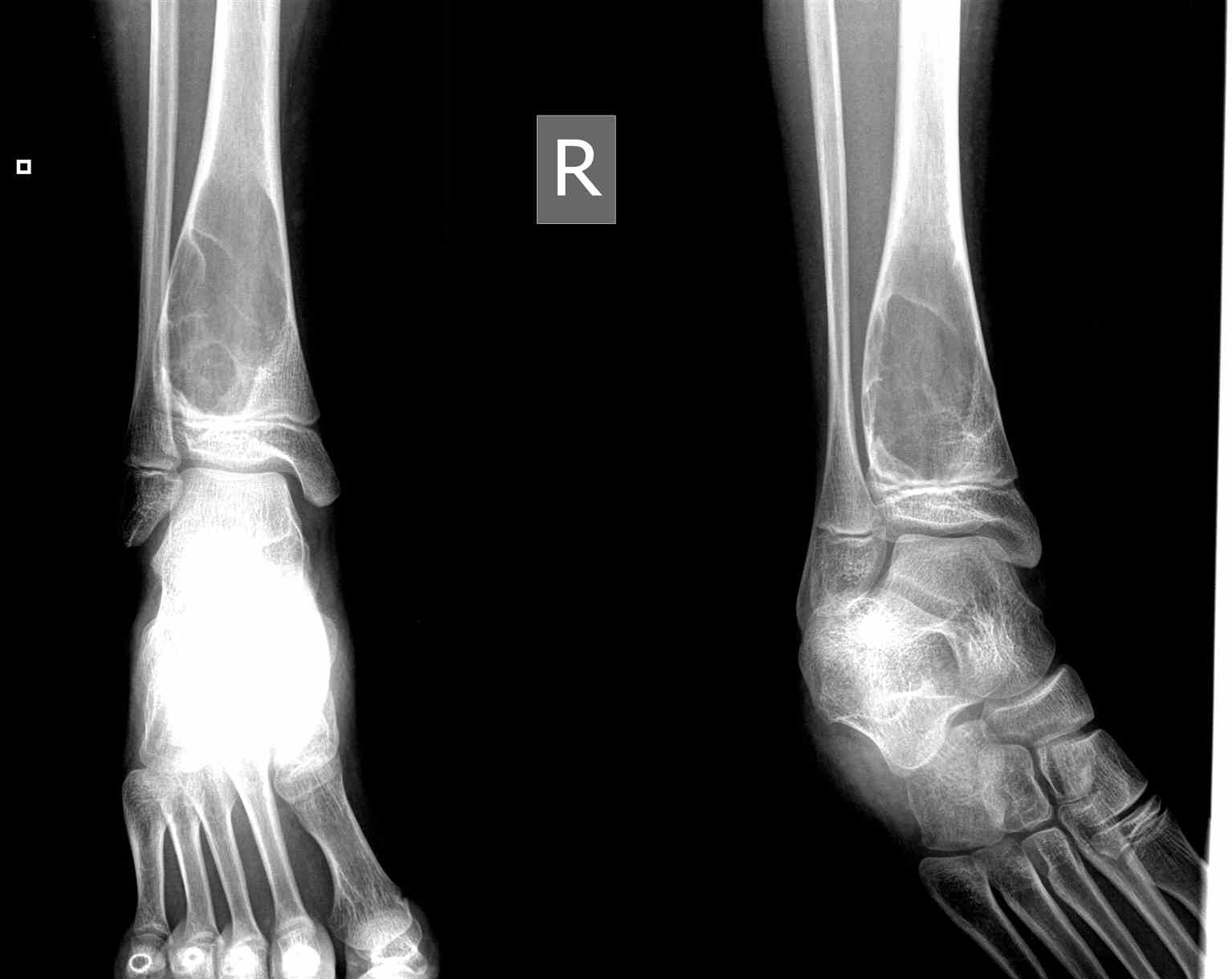 Radiograph Ankle ABC Aneurysmal Bone Cyst  Well Defined Expansile Lytic Lesion in Child with Internal Septations