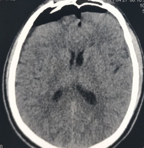 Mount Fuji sign in tension pneumocephalus