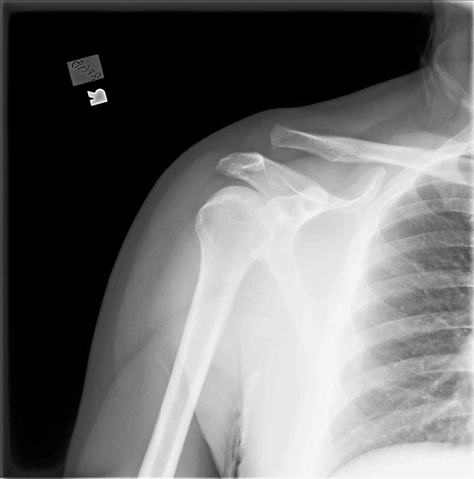 Radiograph Shouder AC Joint Separation/Injury Type III/IV