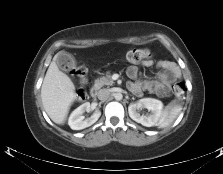 CT Abdomen Acute Cholecystitis