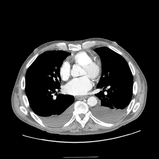 CT Chest Bilateral Pleural Effusions