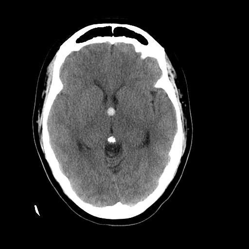 <p>Colloid Cyst, Head Computed Tomography