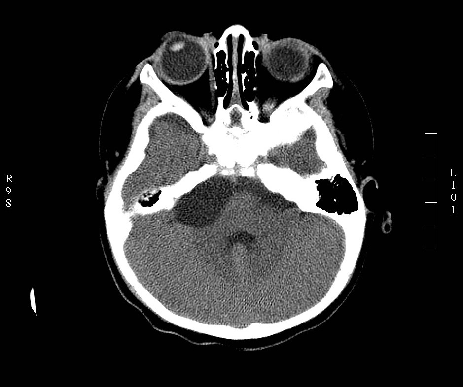 CT head CP angle Arachnoid Cyst