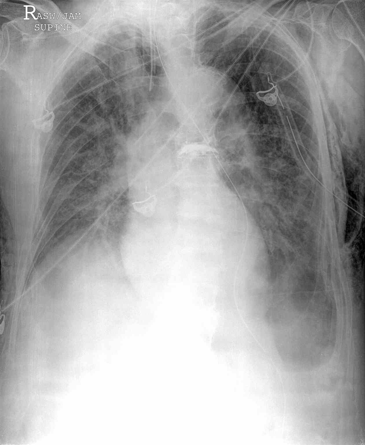 Portable Chest Radiograph Left Deep Sulcus Pneumothorax