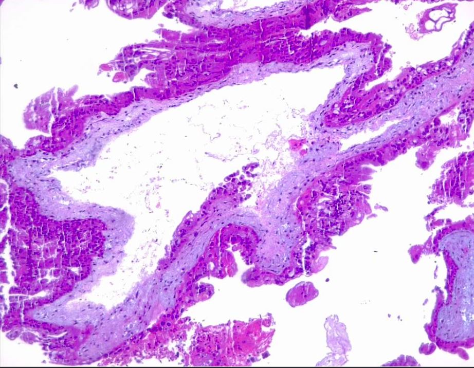 Irregular, indented villi with lace-like trophoblast proliferation. Partial hydatiform mole, H/E 4x.