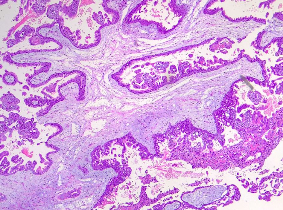 Dismorphic villi in hydatiform mole. H/E 4x