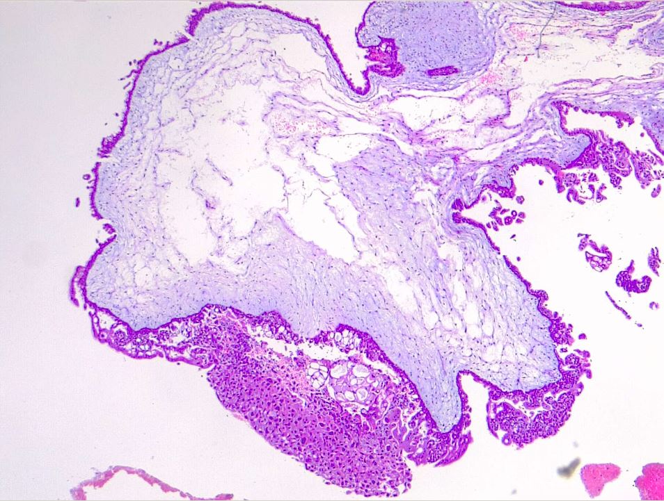 Hydropic villi and trophoblastic proliferation. Hydatiform mole, H/E 4x.