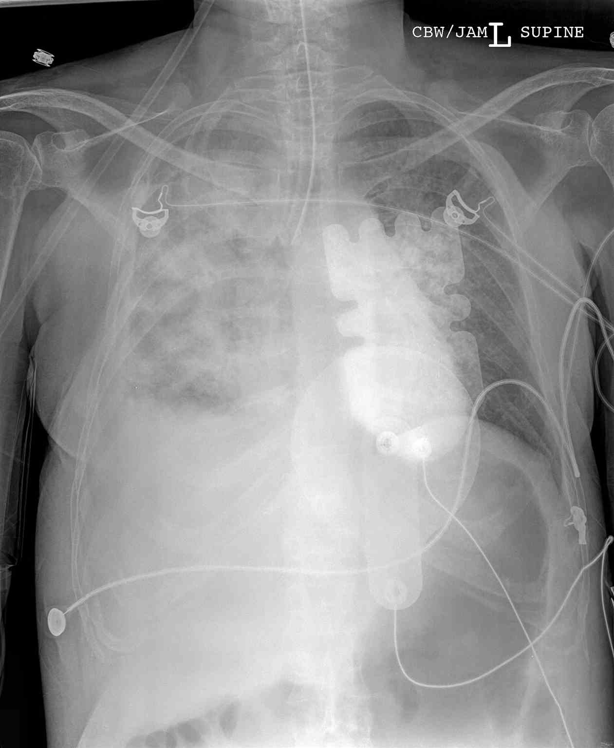 Chest Radiograph Endotracheal tube Right Mainstem Bronchus