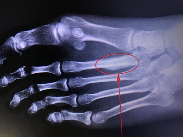 Stress or March Fracture of the second metatarsal