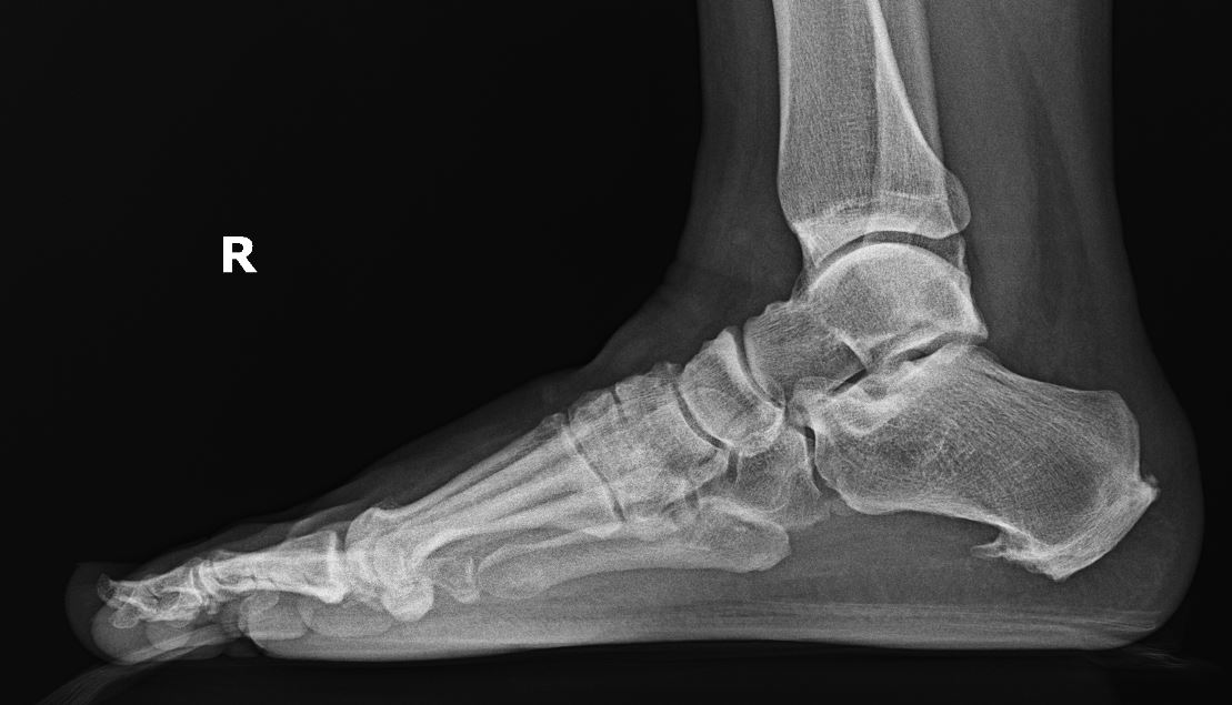 Plantar Heel Pain- note the large plantar calcaneal spur, commonly seen with plantar fasciitis and bursitis