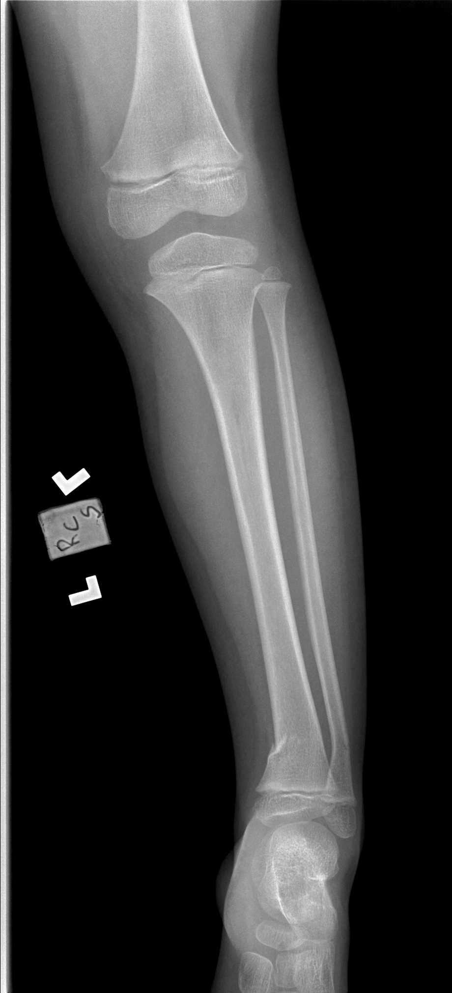 Tibia Fibula Radiograph Greenstick Fracture