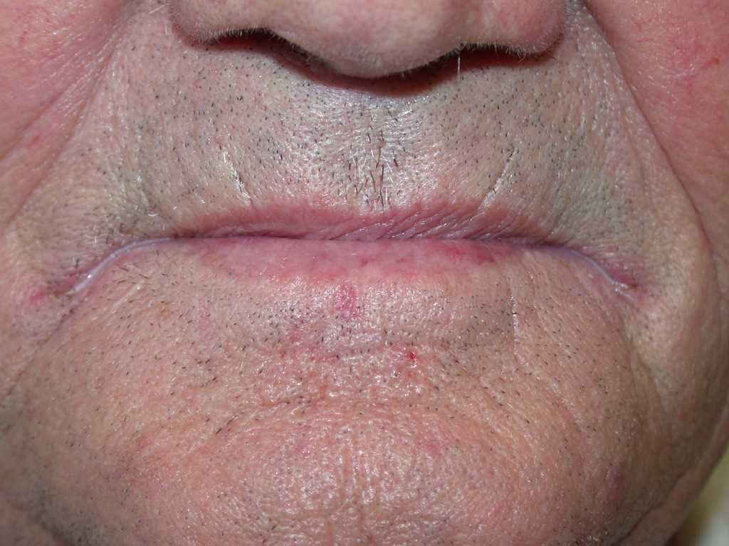 Angular Cheilitis