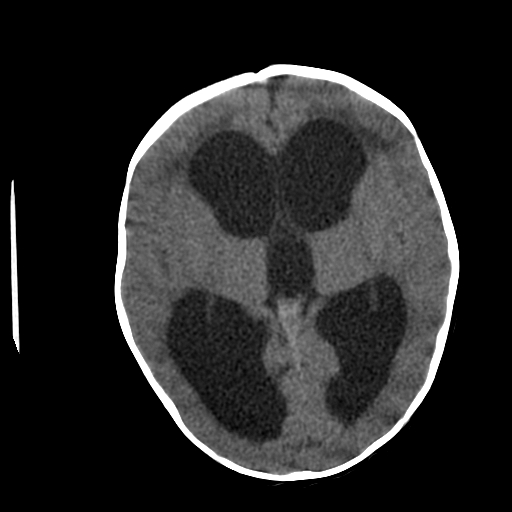 CT Head Hydrocephalus