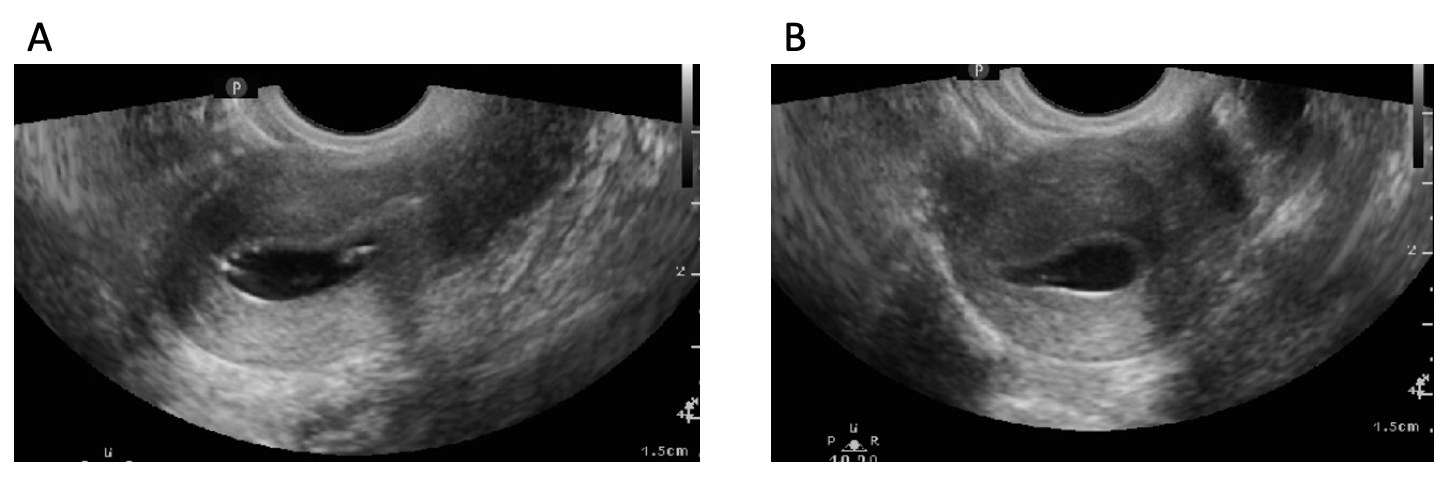 Figure 8: A) sagittal and (B) transverse views of a normal uterine cavity in Saline Infusion Sonogram (SIS)