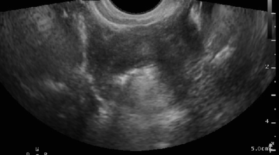 Figure 9:  SIS showing patent fallopian tube (hyper-echoic bubbles seen flowing through the cornua and outside of the uterine