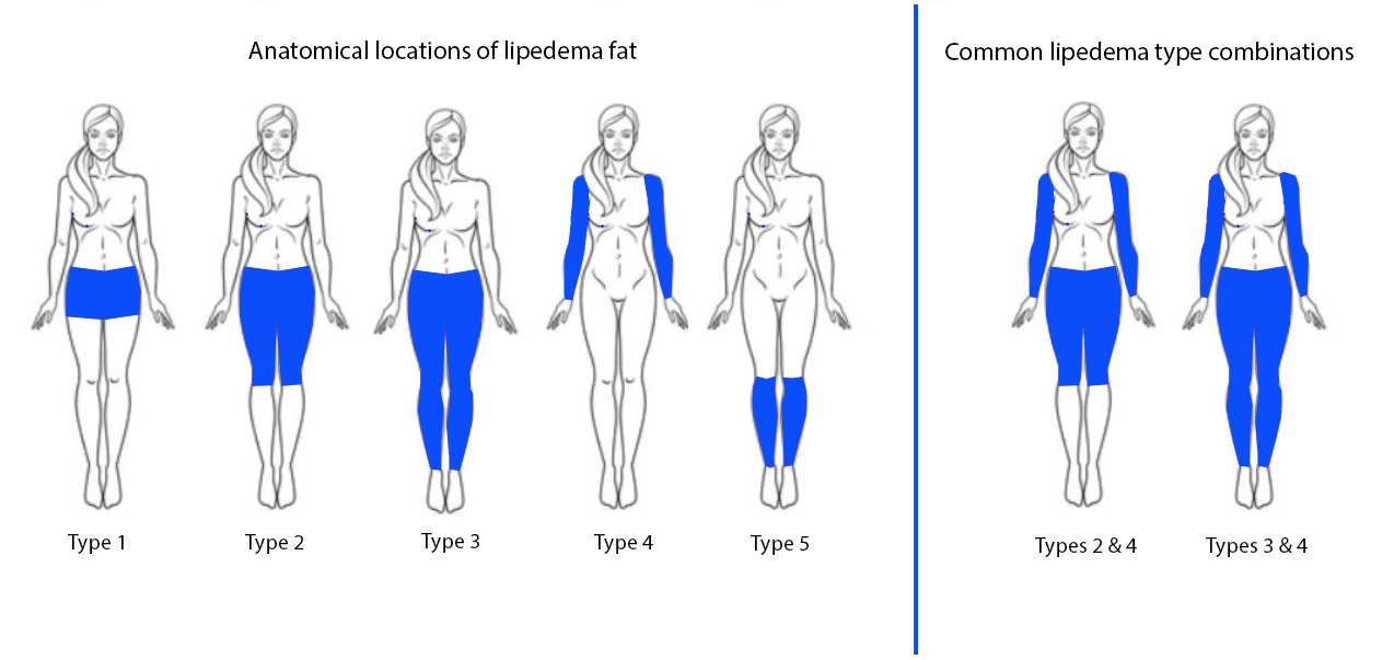 Lipedema Types