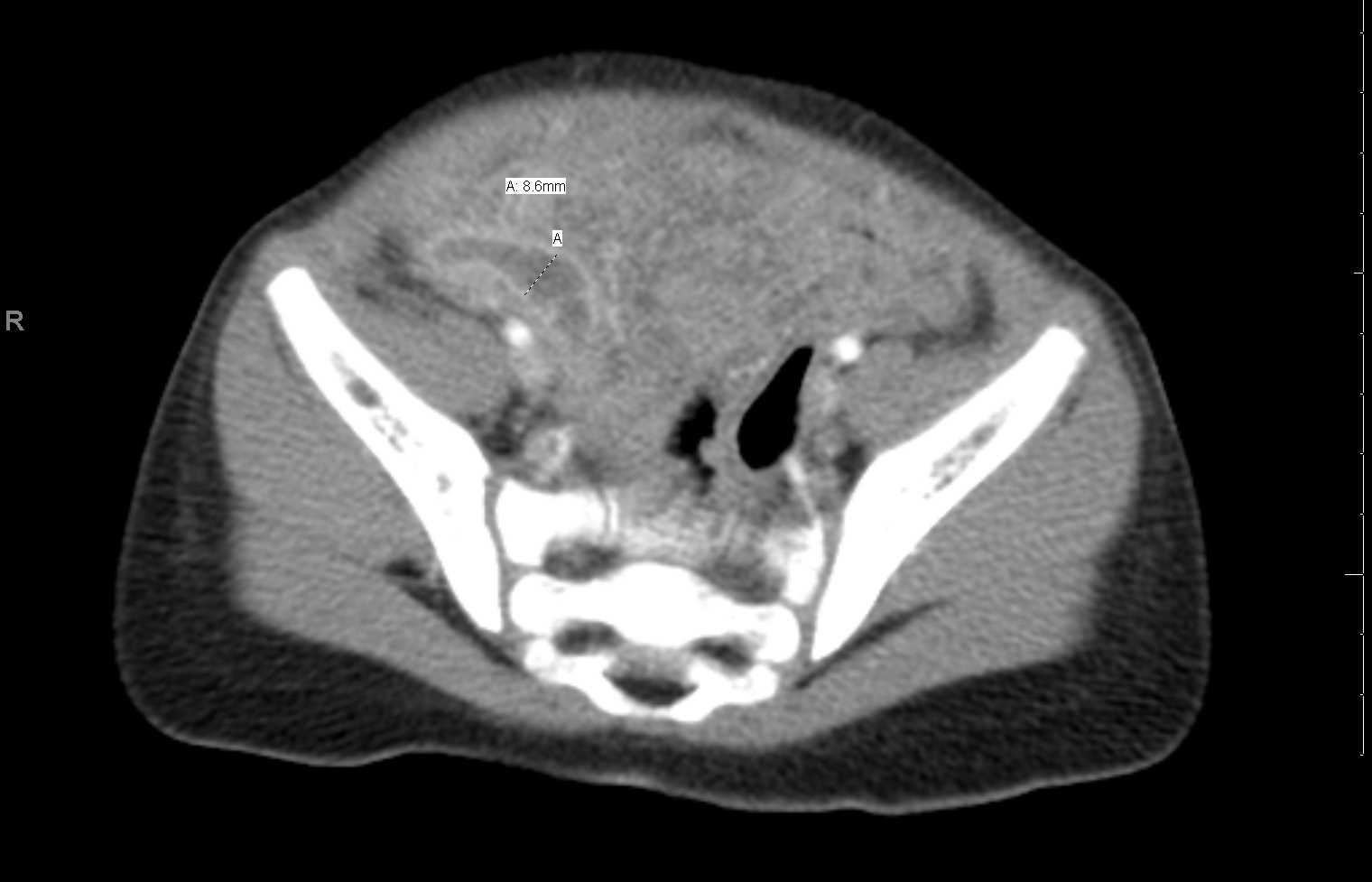 CT Abdomen Acute Appendicitis