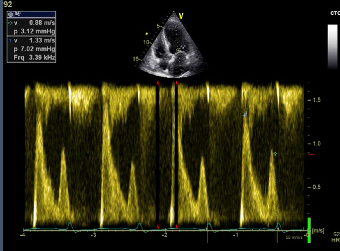 Figure.3
Pulsed wave (PW) Doppler at mitral inflow.